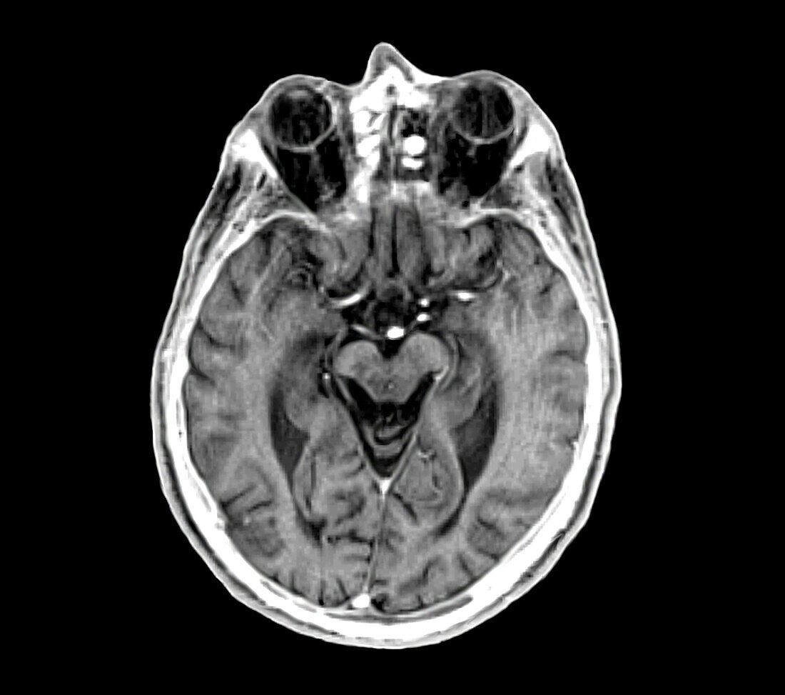 Cerebral atrophy, illustration