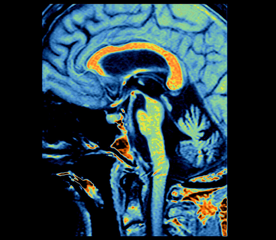 Progressive supranuclear palsy, MRI scan