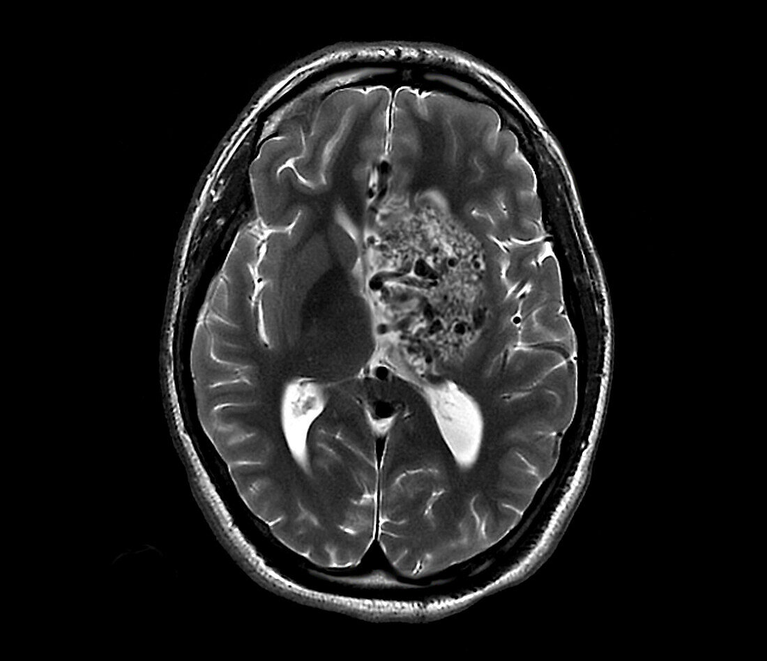Subarachnoid hemorrhage, MRI scan