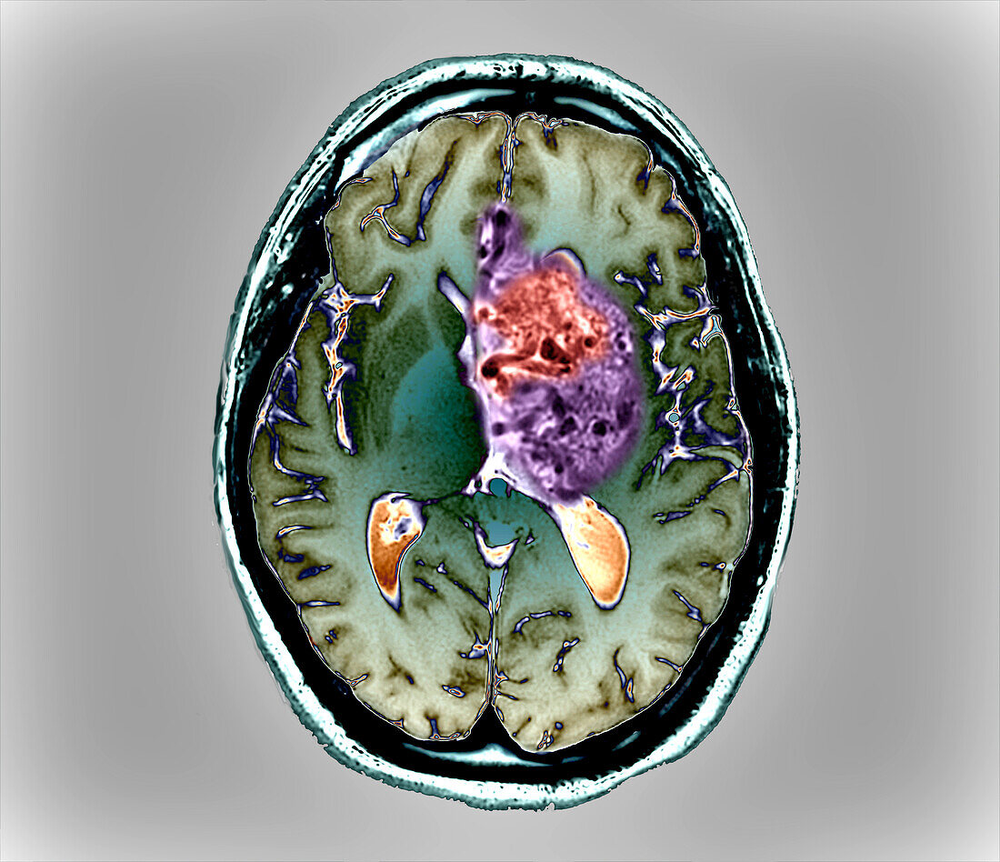 Subarachnoid hemorrhage, MRI scan