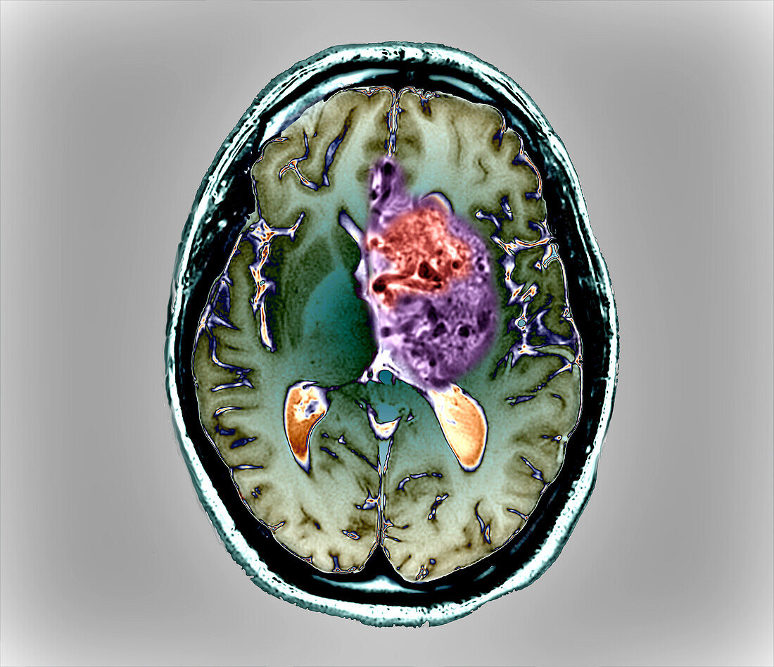 Subarachnoid Hemorrhage Mri Scan Bild Kaufen 13599592 Science