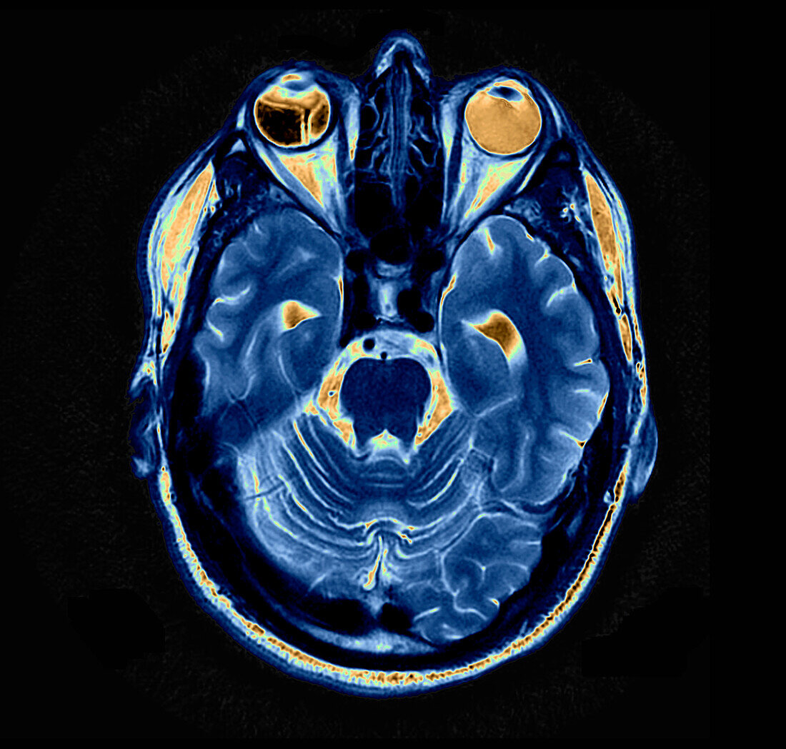 Retinal detachment, MRI scan