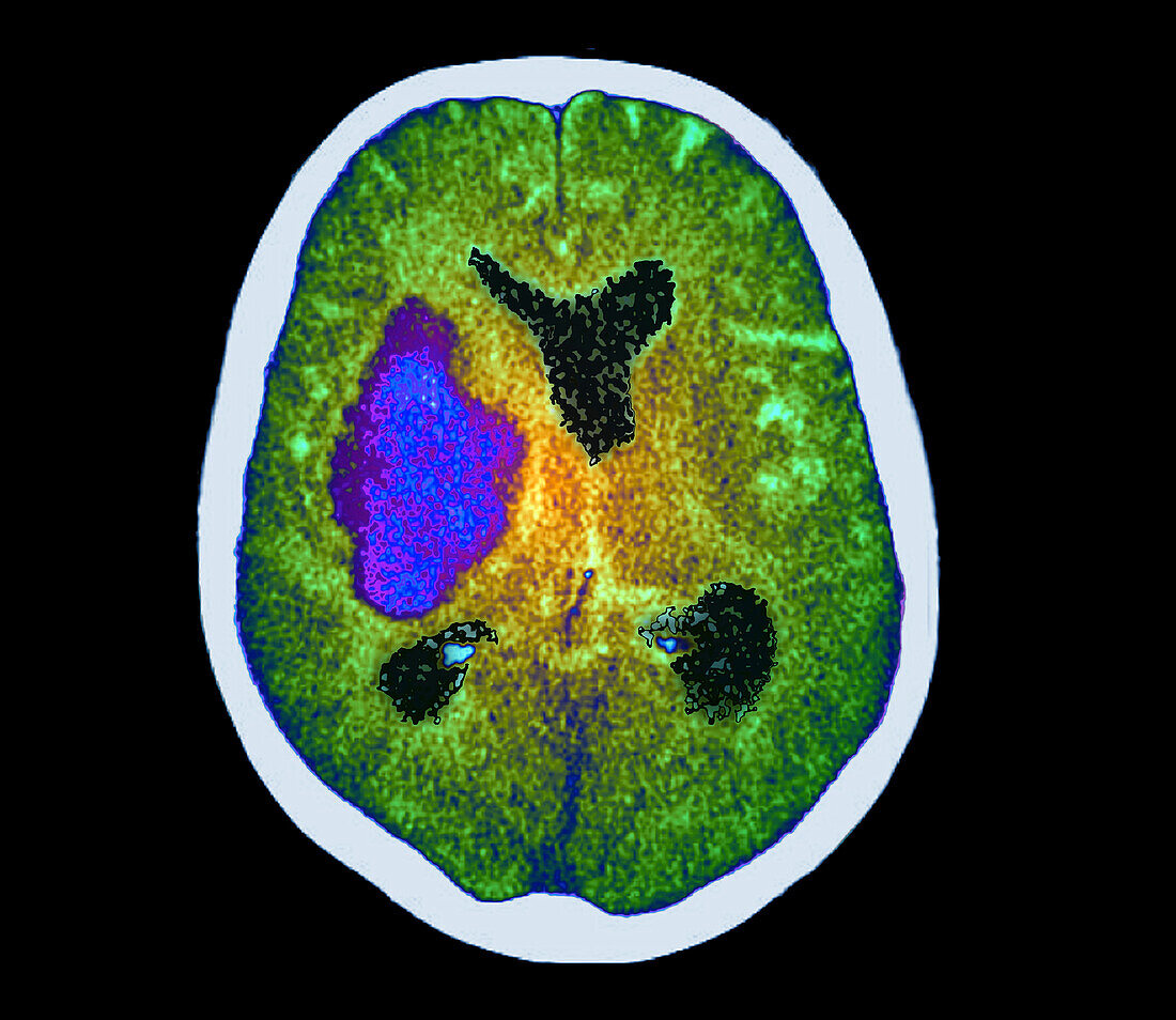 Cerebral haemorrhage, CT scan