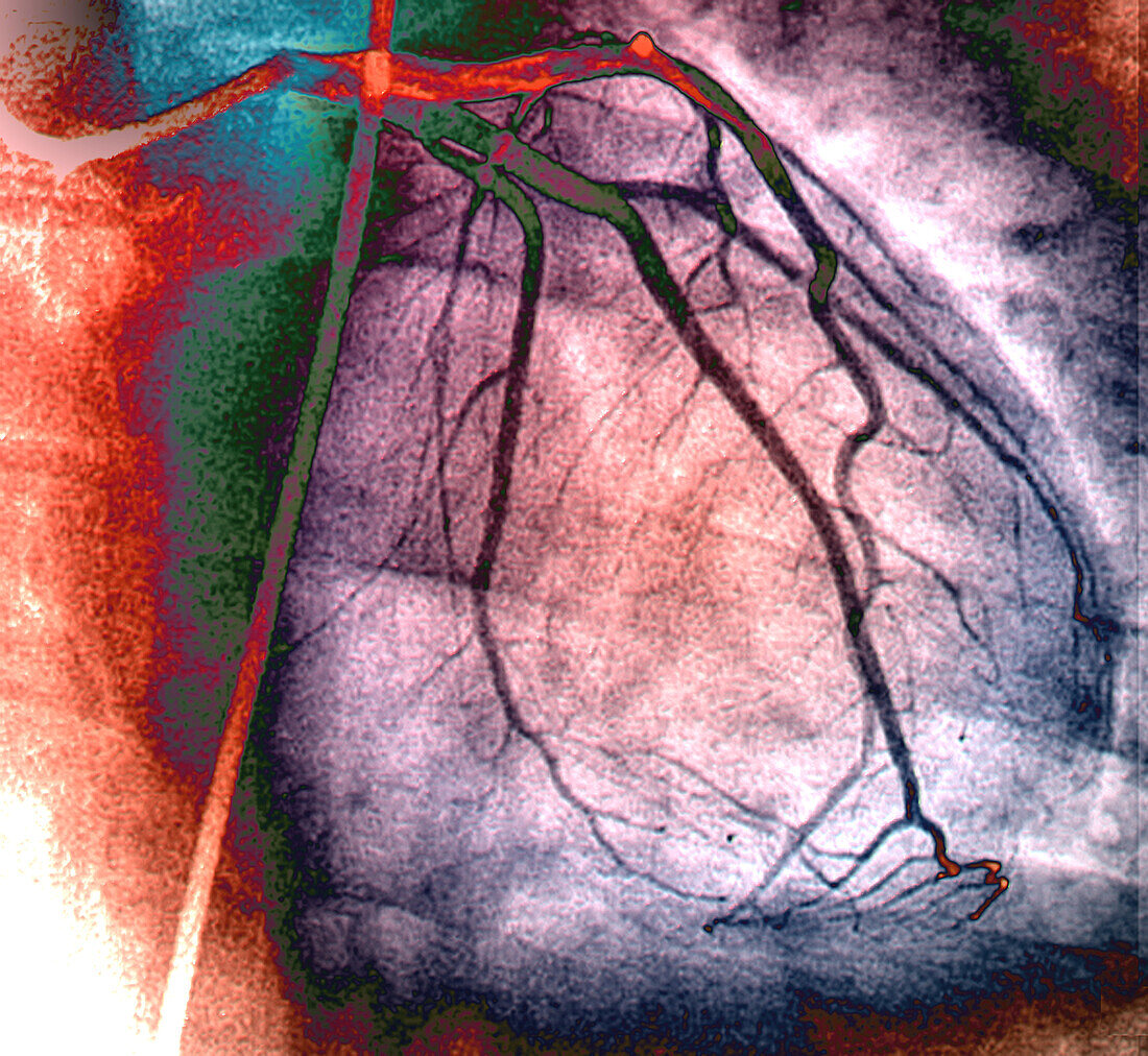 Normal left coronary network, angiogram