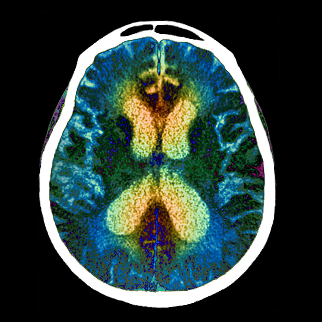 Alzheimer's disease, CT scan