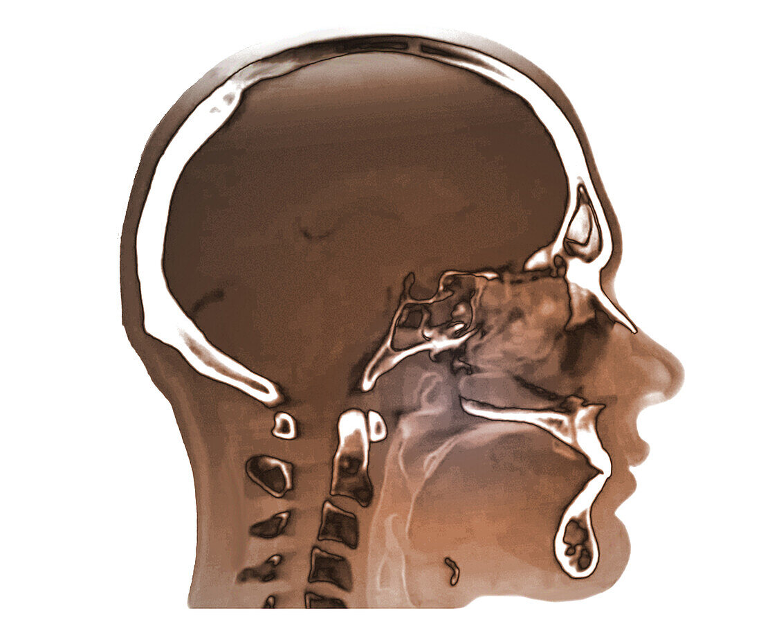 Normal nasopharynx, CT scan