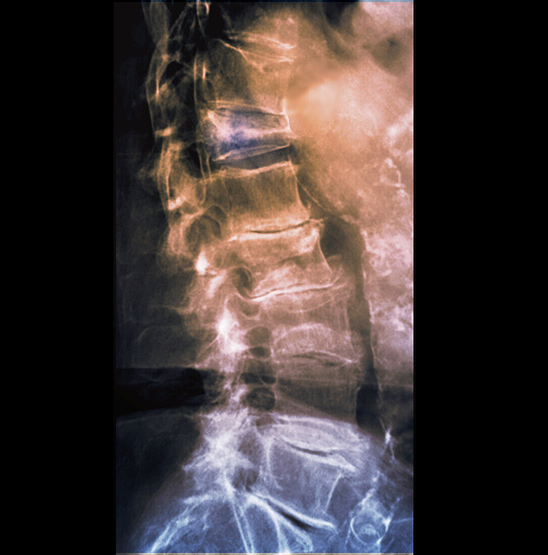 Osteoarthritis of the lumbar spine, X-ray