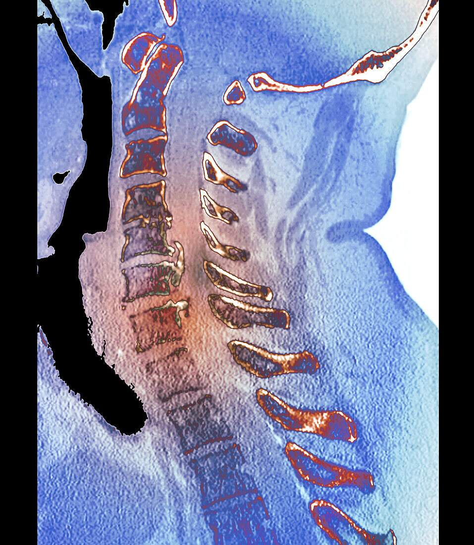 Osteoarthritis of the cervical spine, CT scan