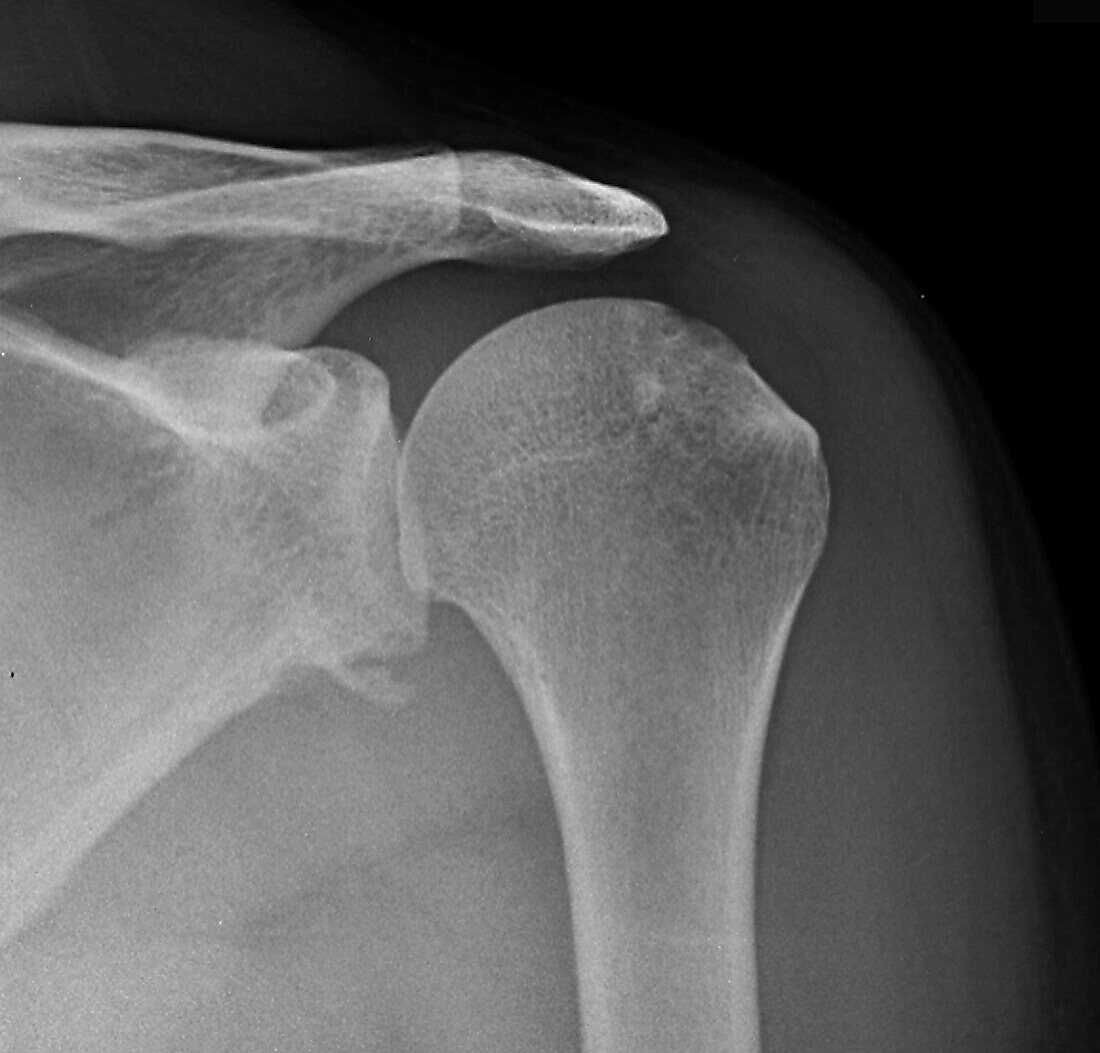 Bone fragment of the left shoulder, X-ray