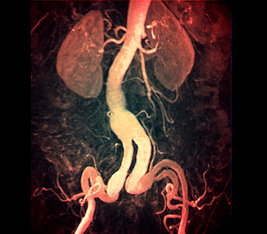 Aneurysm of iliac and renal arteries, MRI angiogram