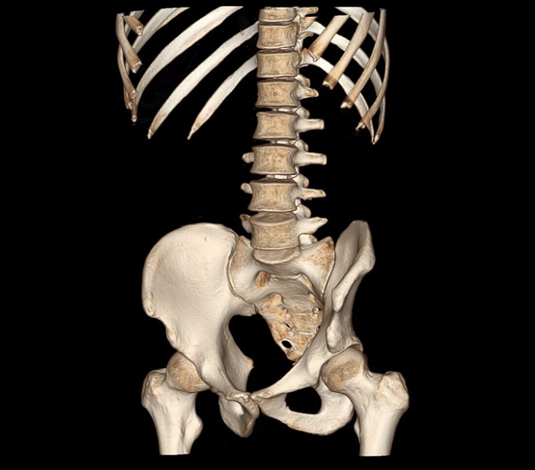 Healthy lower spine, CT scan