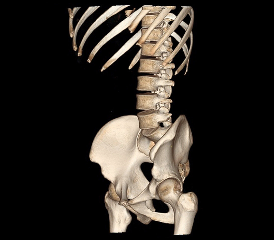 Healthy lower spine and hips, CT scan