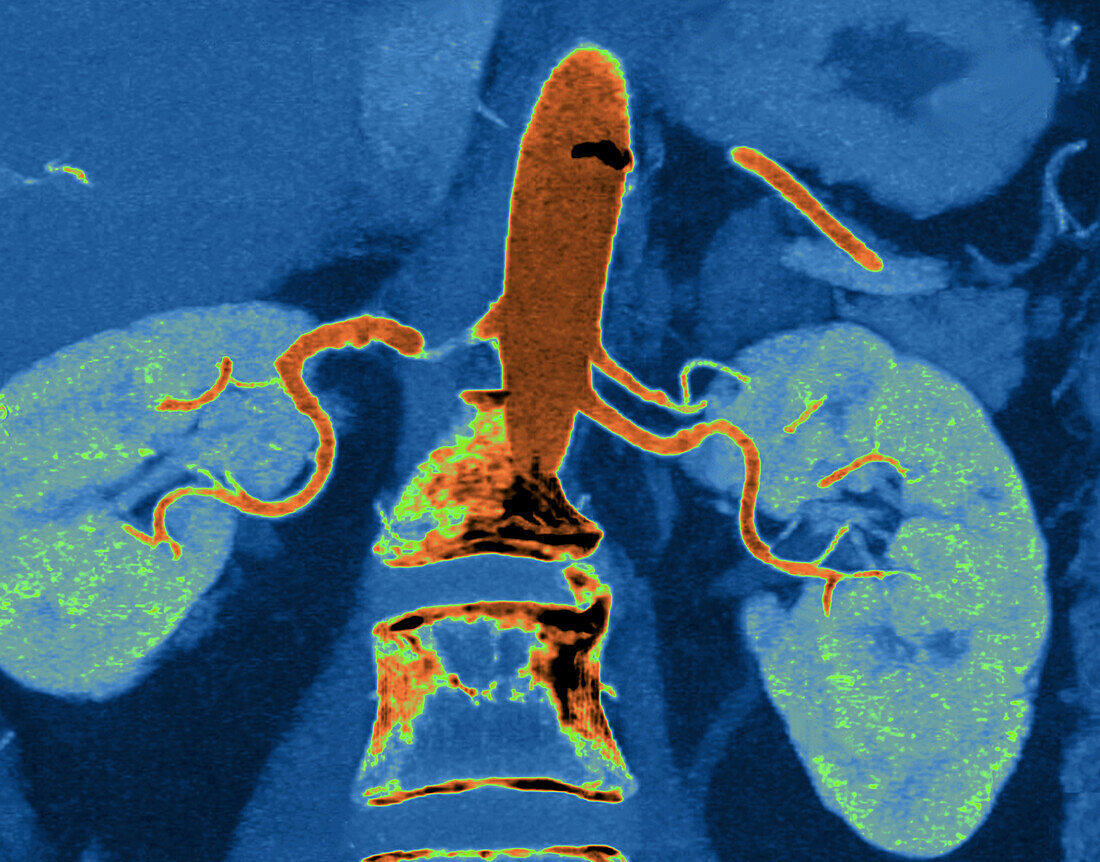 Fibromuscular dysplasia of the renal artery, CT angiogram