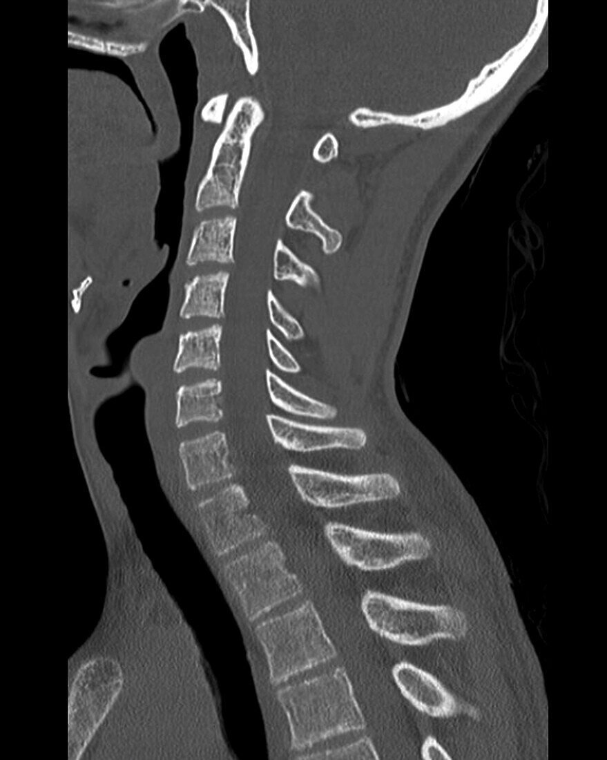 Healthy cervical spine, CT scan