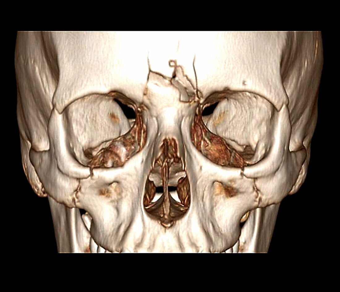 Le Fort skull fractures, CT scan