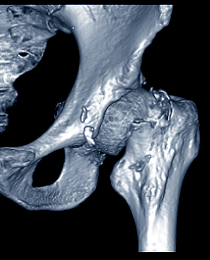Hip fracture, CT scan