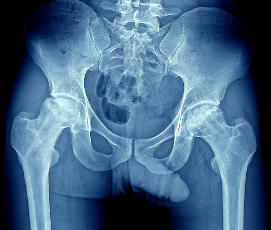 Painful hips, X-ray