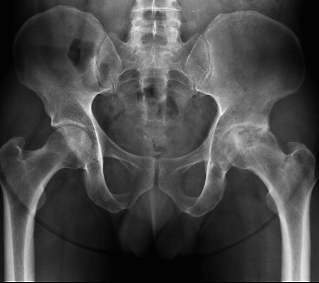 Osteonecrosis of the hips, X-ray