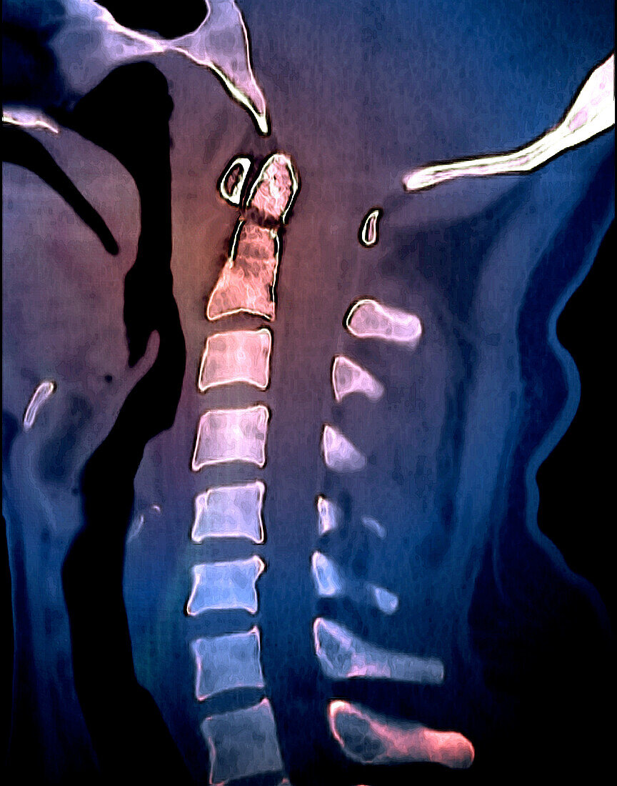Odontoid process fracture, CT scan