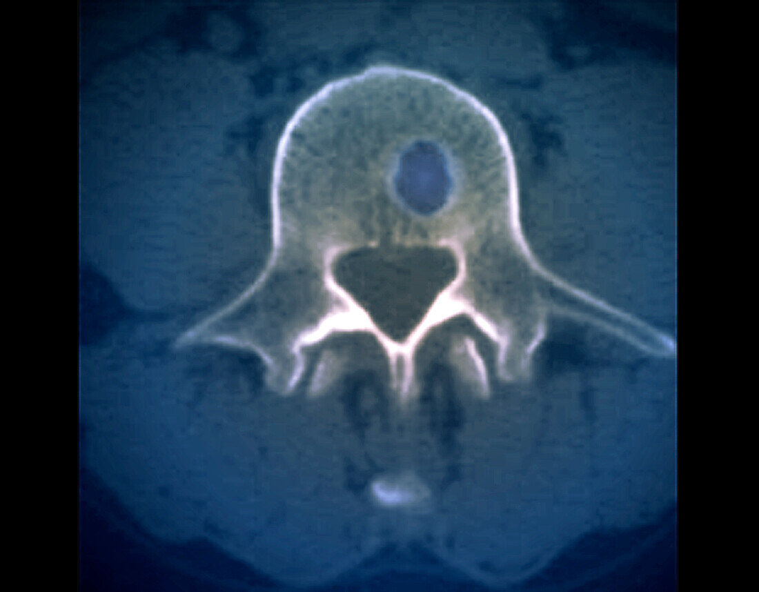 Schmorl's node, CT scan