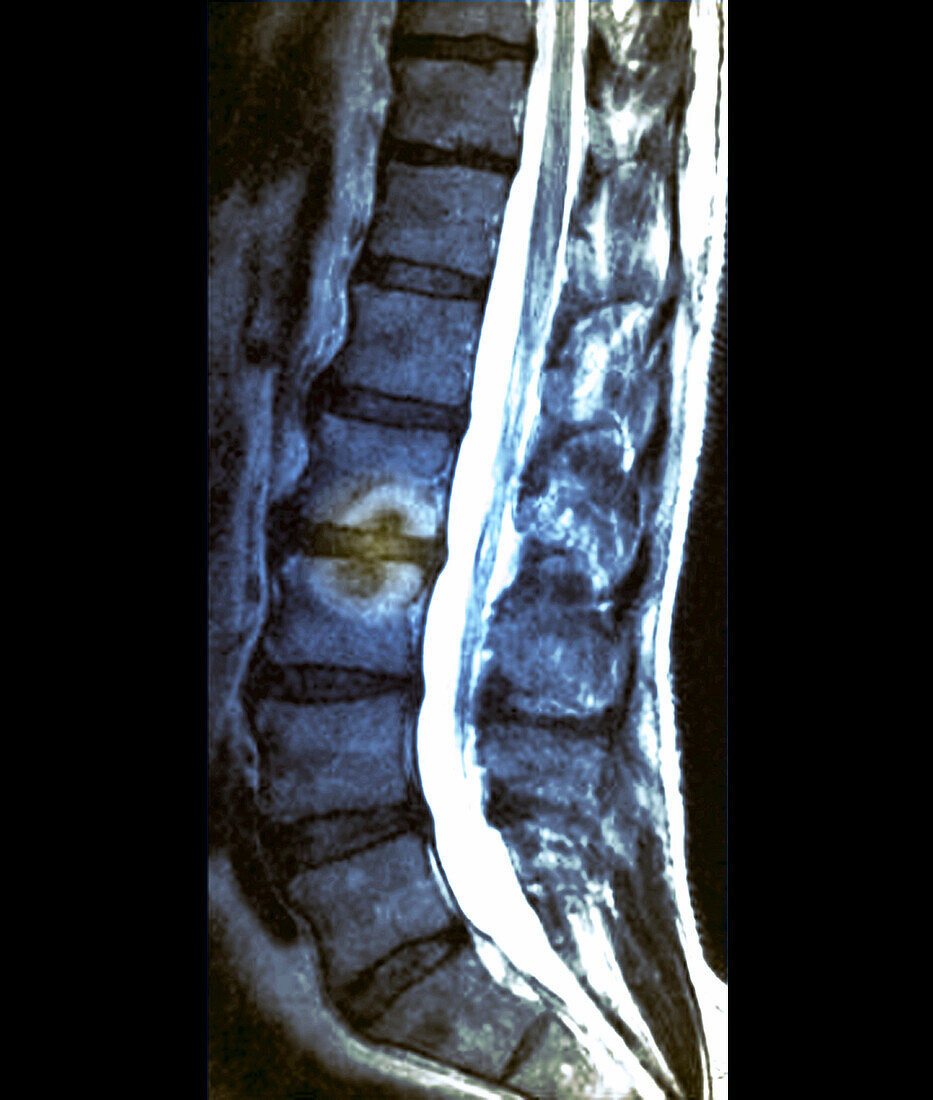 Schmorl nodules, MRI scan