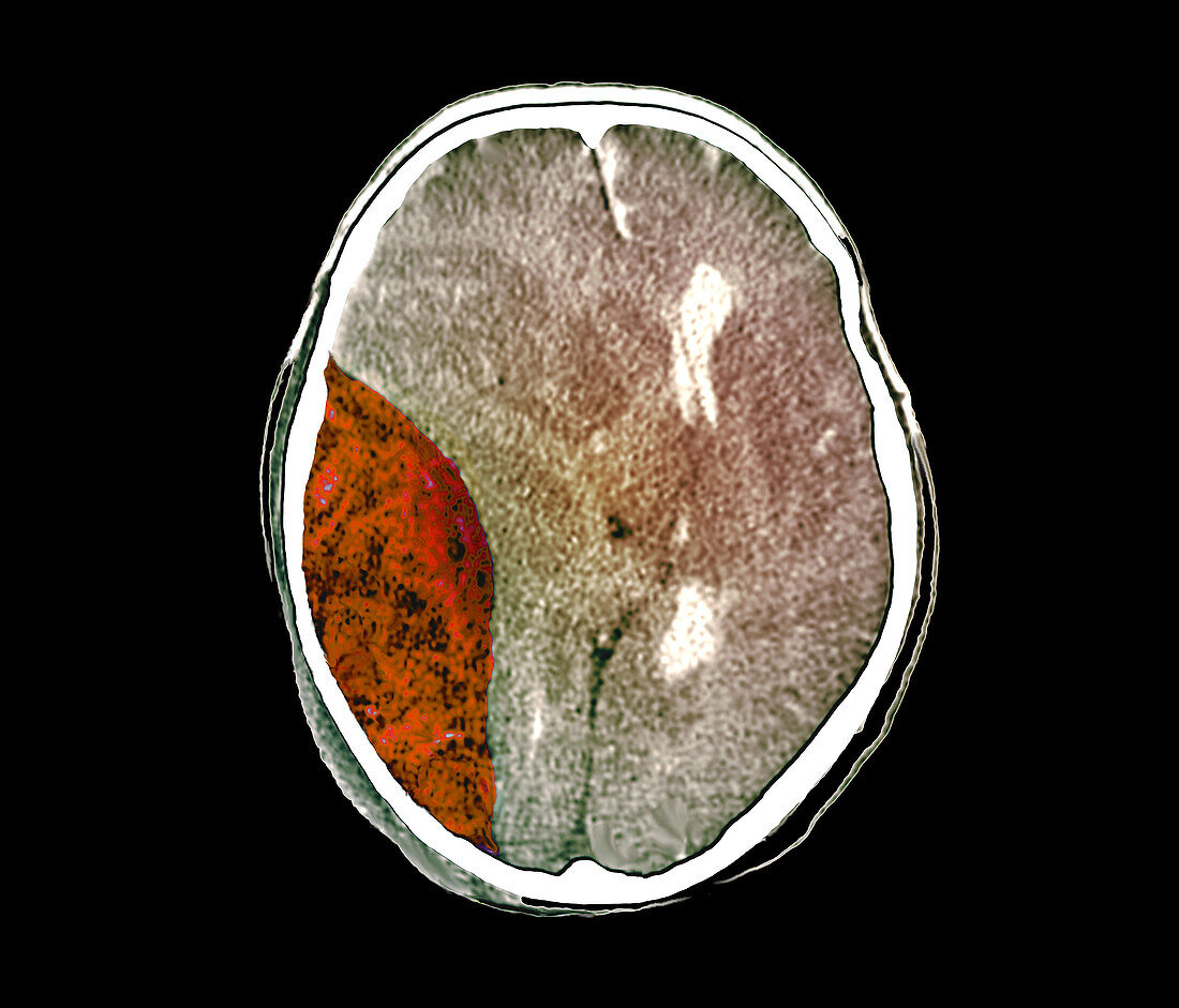 Extradural haematoma, CT scan