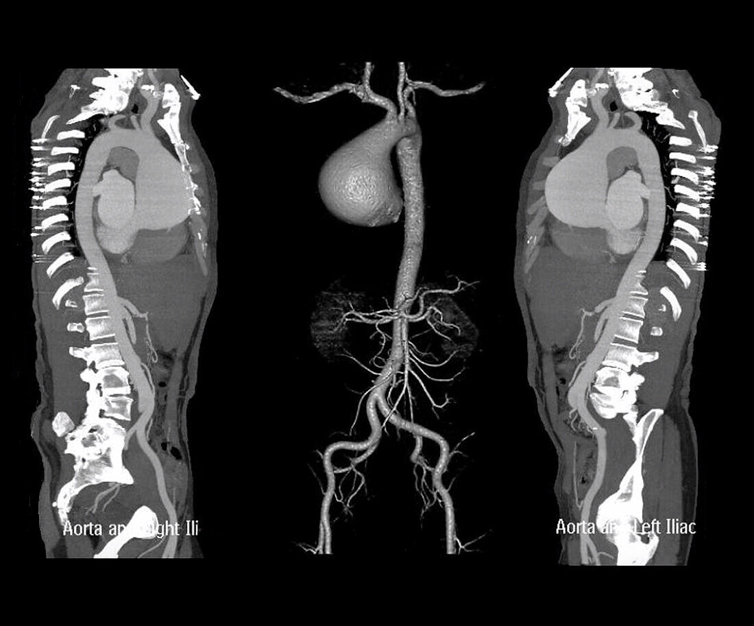 Ascending aortic aneurysm, CT angiogram