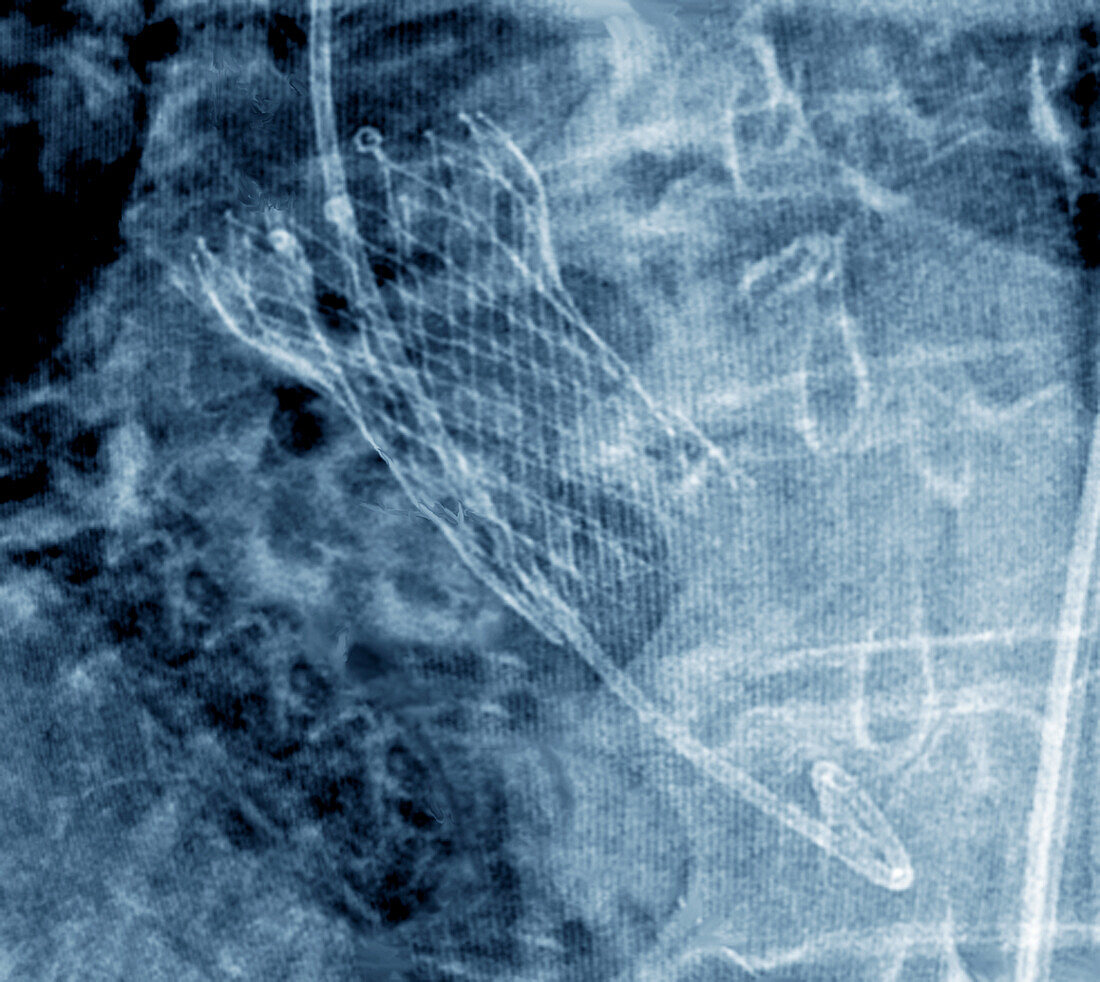 Prosthetic aortic valve, X-ray