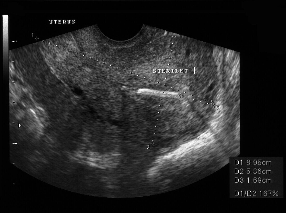 Normal uterus, ultrasound scan