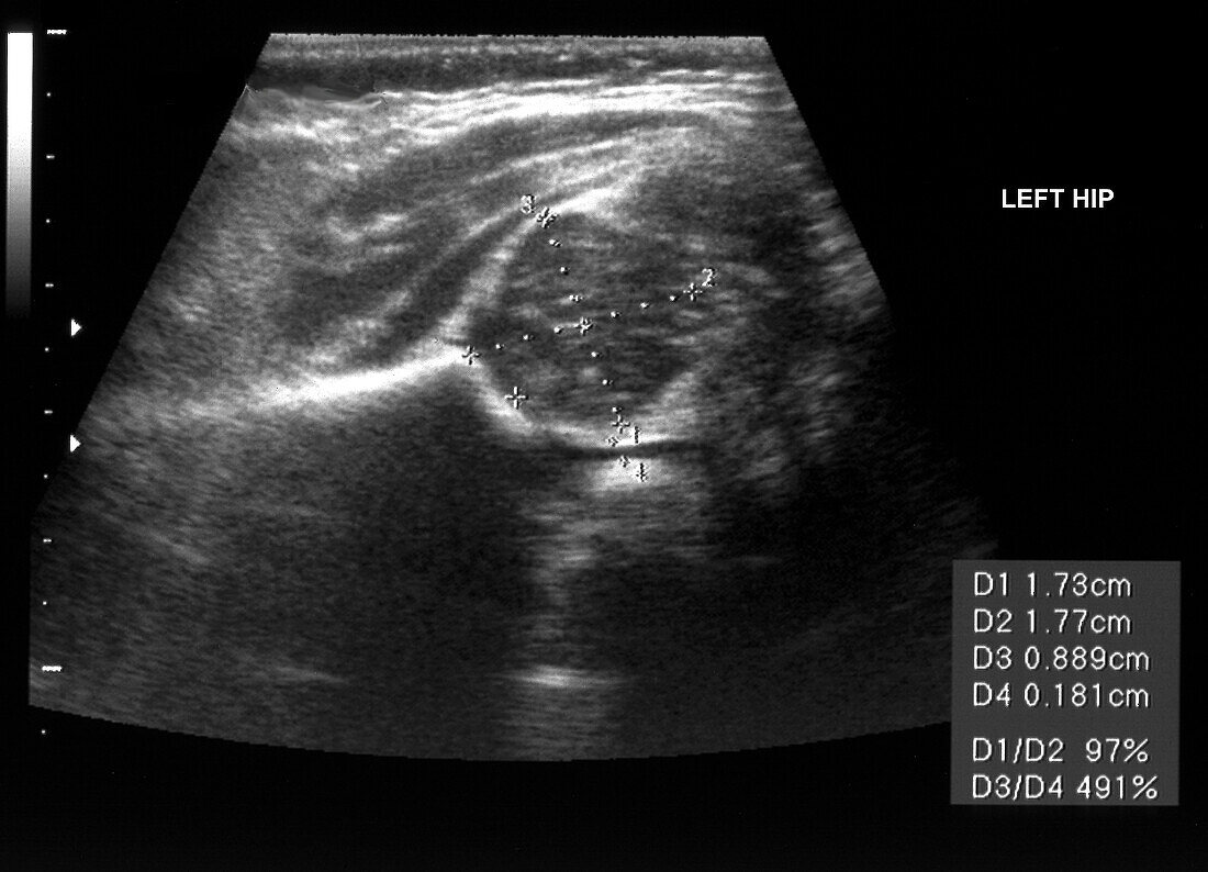 Healthy left hip of a baby, ultrasound scan