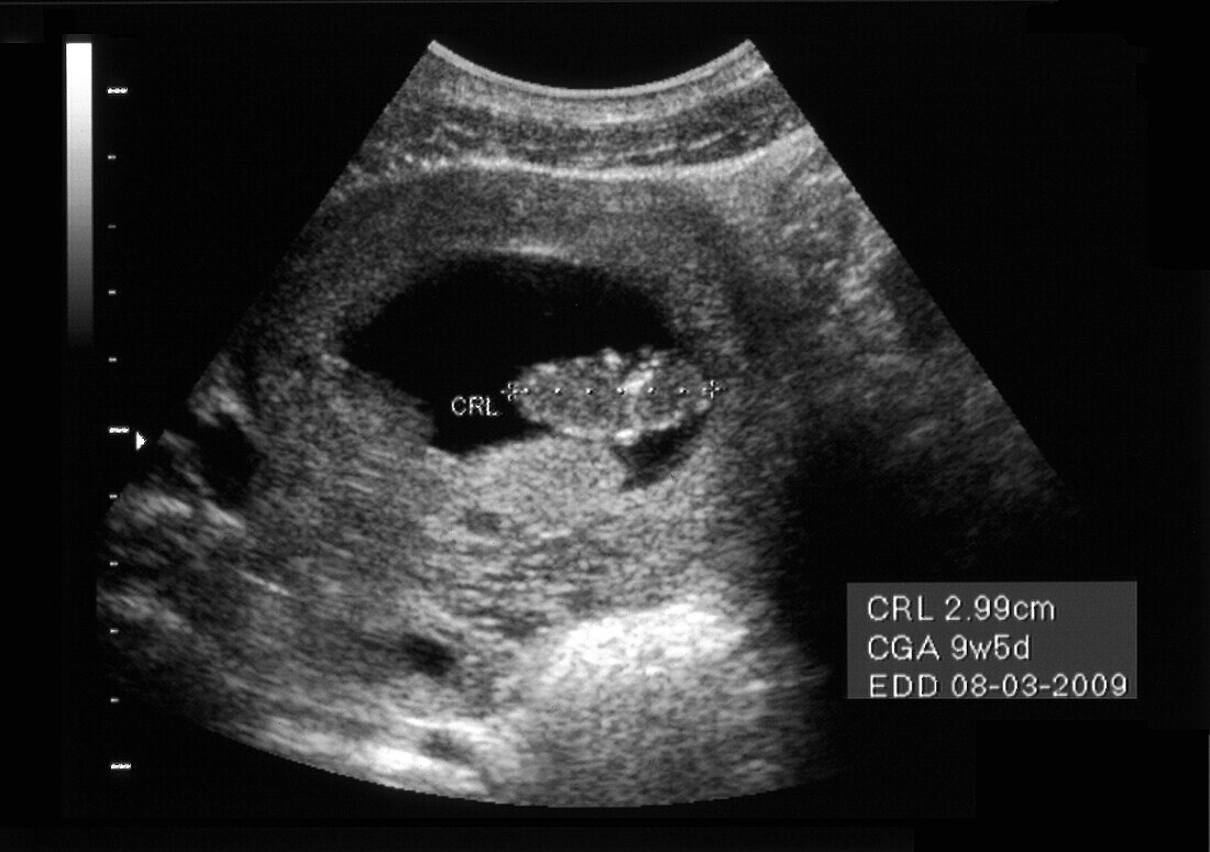 Intrauterine pregnancy, ultrasound scan