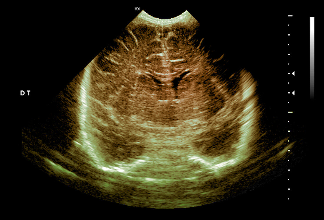 Normal premature newborn baby brain development, ultrasound