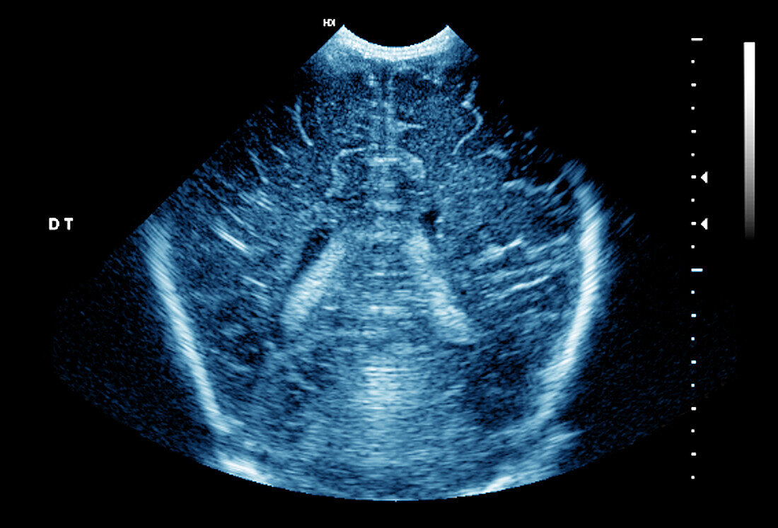 Normal premature newborn baby brain development, ultrasound