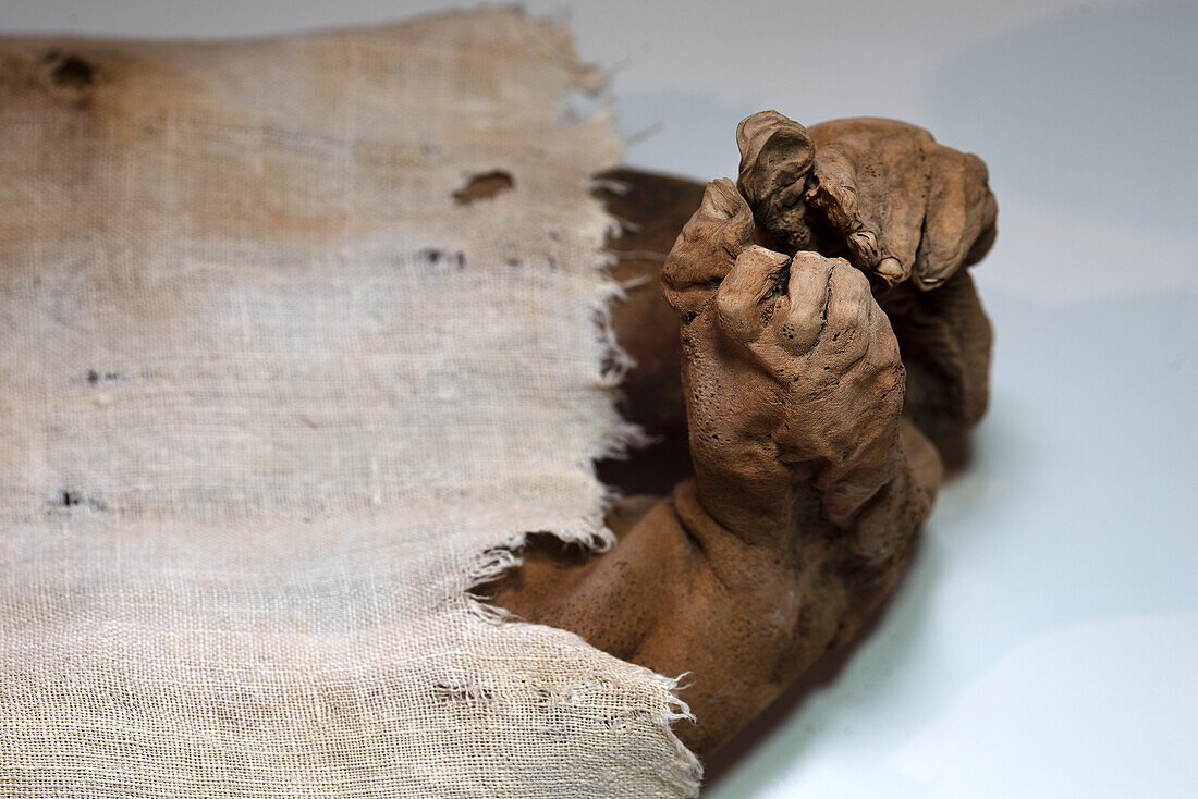 Club feet of an infant human mummy