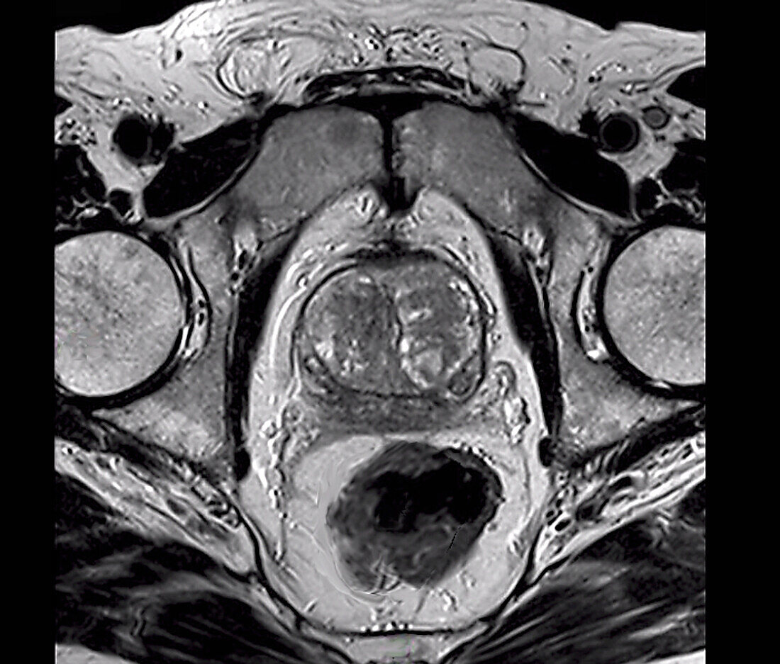 Benign prostatic hyperplasia, MRI scan