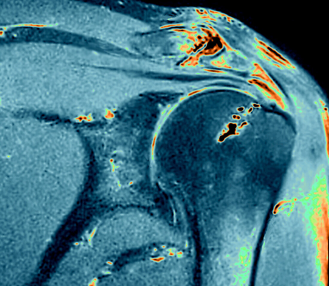 Calcified tendinitis, MRI scan