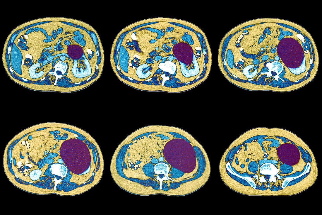 Kidney cyst, CT scans