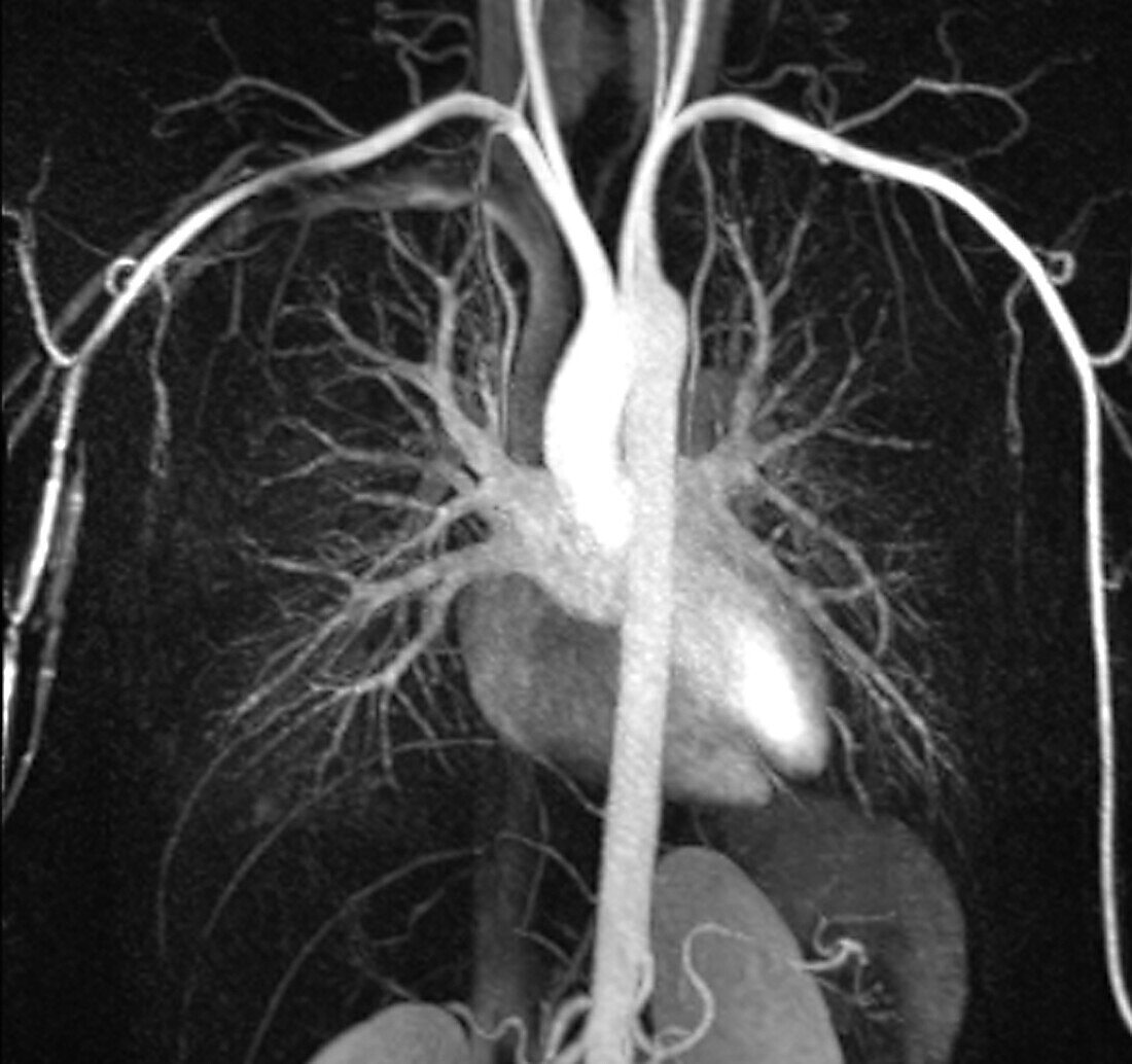 Heart and torso blood vessels, MRI angiogram