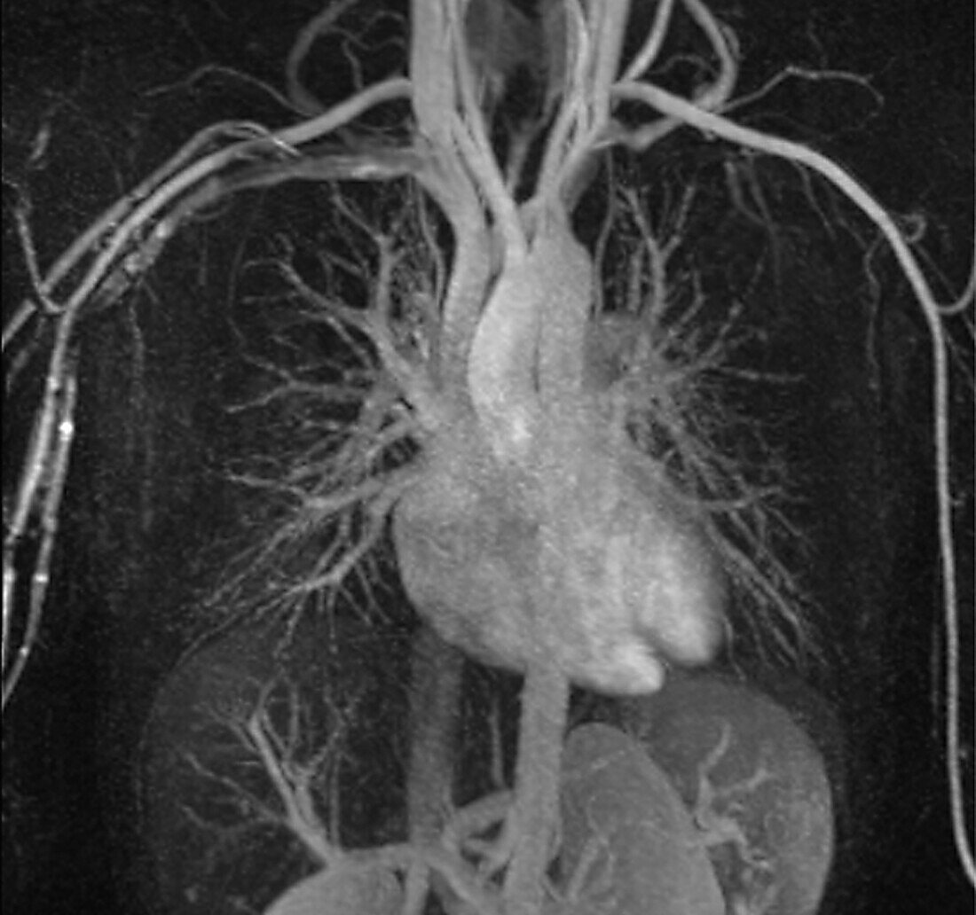 heart-and-blood-vessels-mri-angiogram-bild-kaufen-13600890-science-photo-library