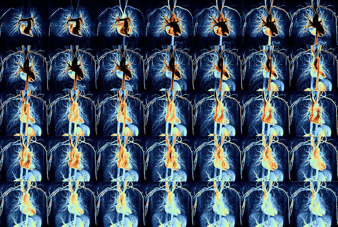 Circulatory system, MRI angiograms