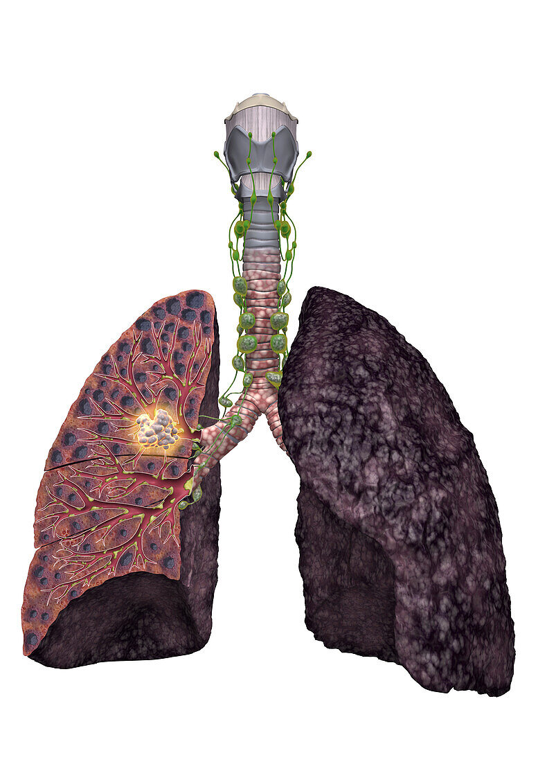 Smoker's lungs with oat cell carcinoma, illustration