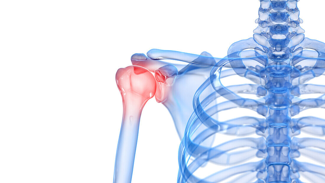 Painful shoulder, illustration