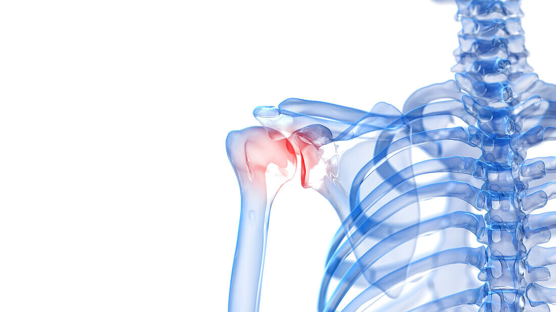 Painful shoulder, illustration