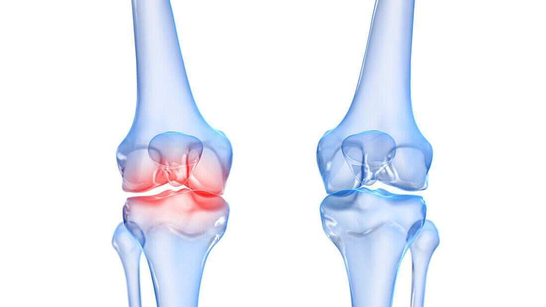 Painful knee, illustration