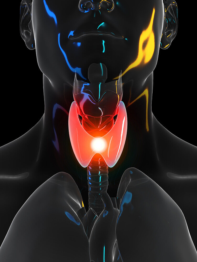 Painful thyroid, illustration