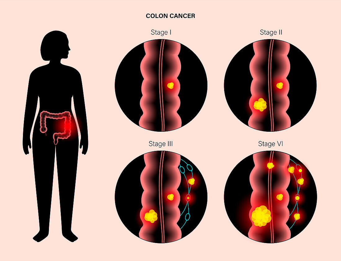 Colorectal cancer, illustration