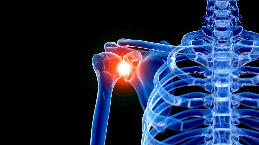 Painful shoulder, illustration