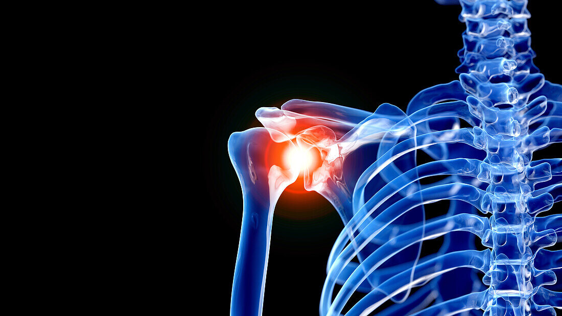 Painful shoulder, illustration