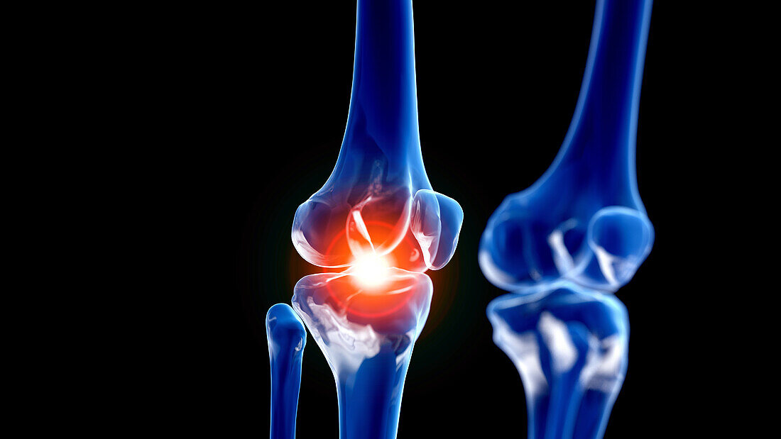 Painful knee joint, illustration