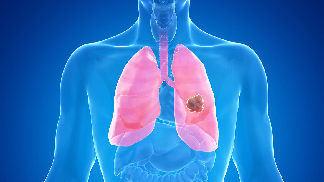 Lung cancer, illustration